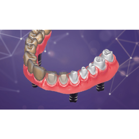 Exocad Software Exocad DentalCAD Ultimate Lab Bundle Perpetual License Yearly Optional Update Fee
